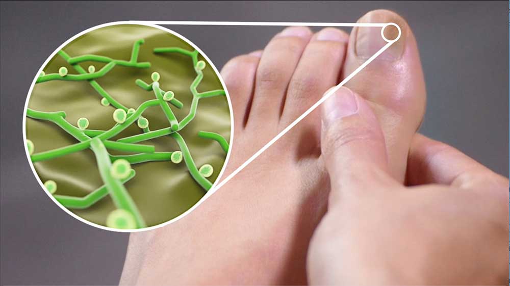 glivice_na_nohtih_mikroskop